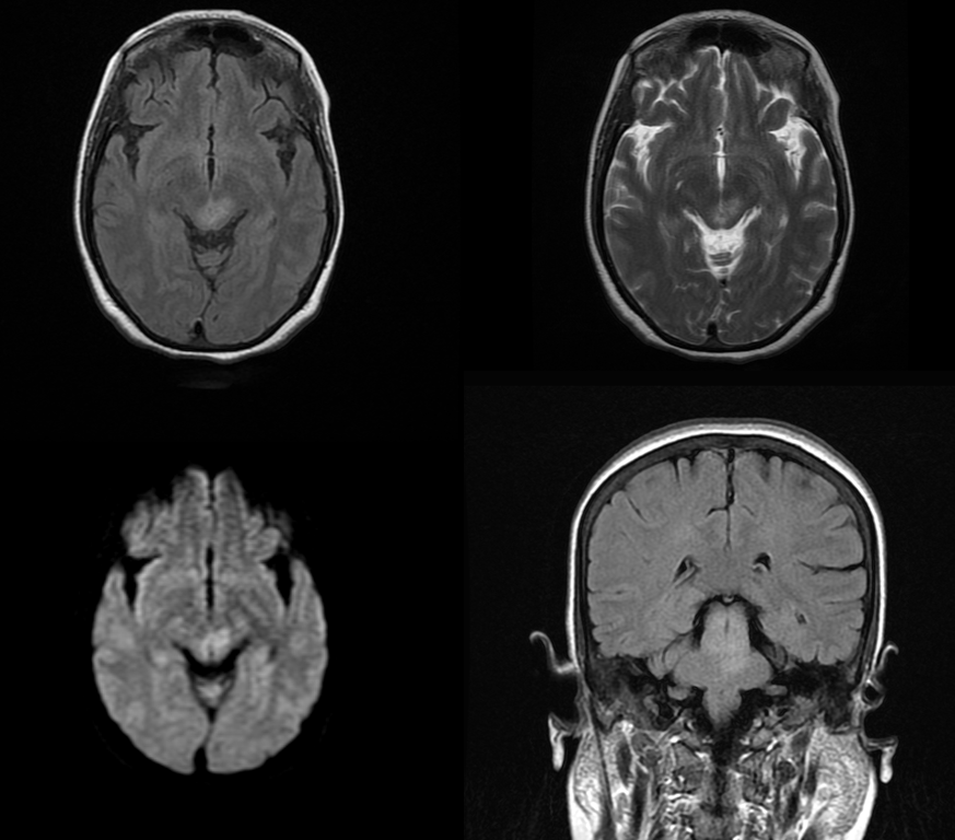頭部MRI-視神経脊髄炎関連疾患2