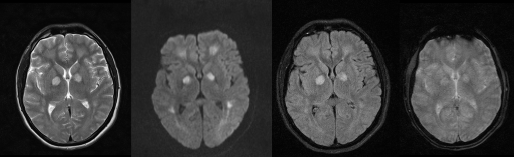 頭部MRI-一酸化炭素中毒