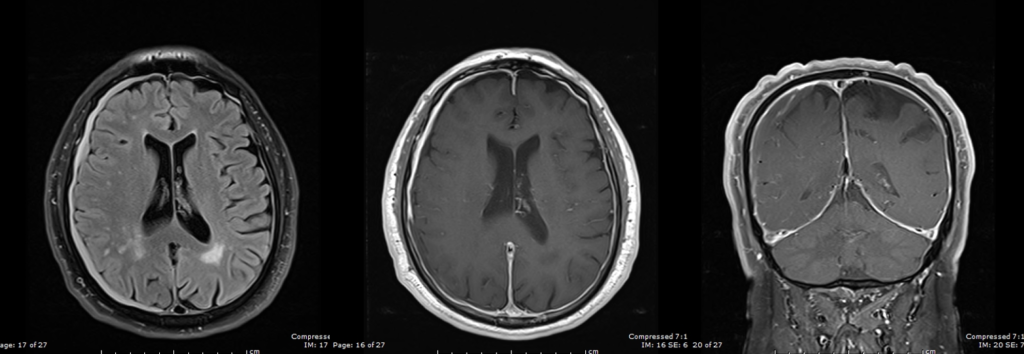 頭部MRI-spontaneous intracranial hypotension suyndrome
