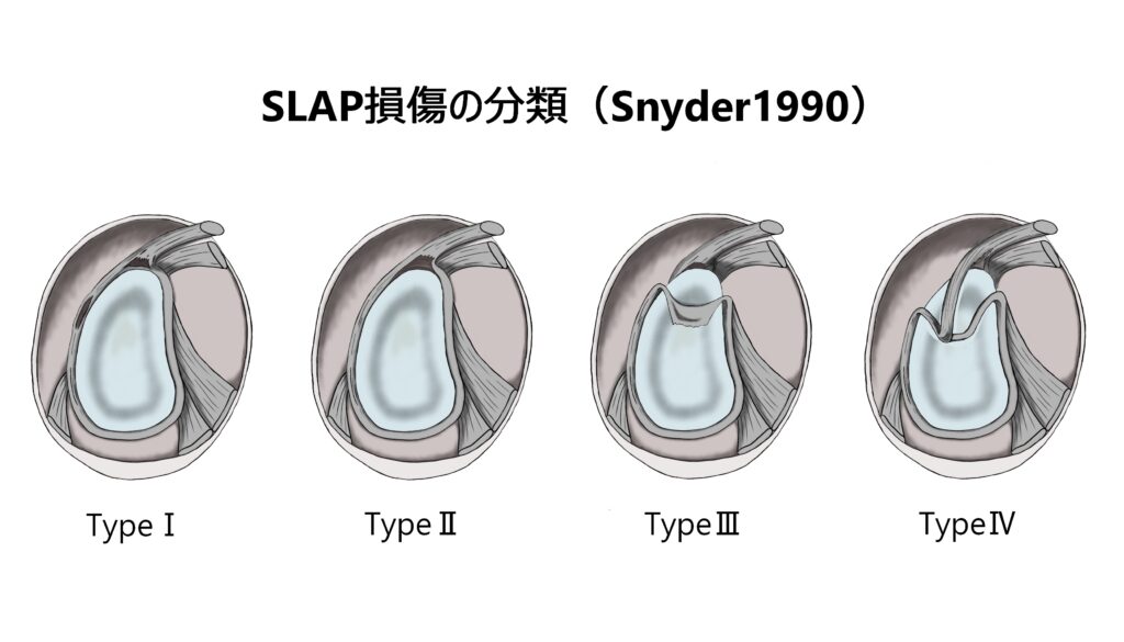 SLAP損傷の分類