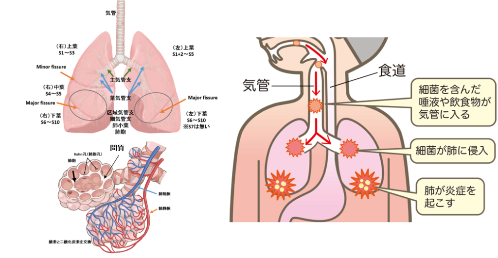 誤嚥性肺炎　イメージ図