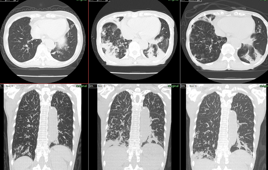 胸部CT　誤嚥性肺炎