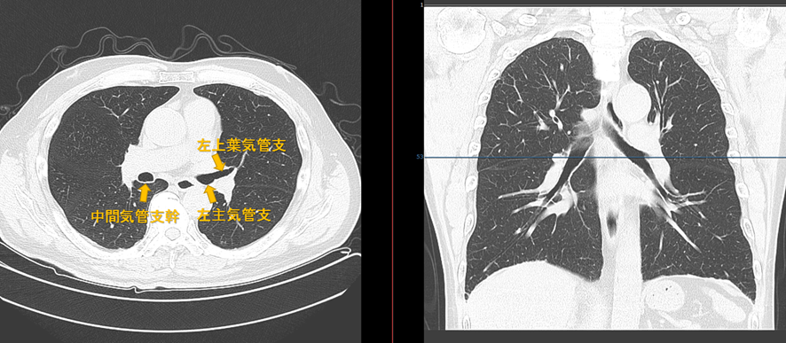 胸部CT　左右主気管支レベル
