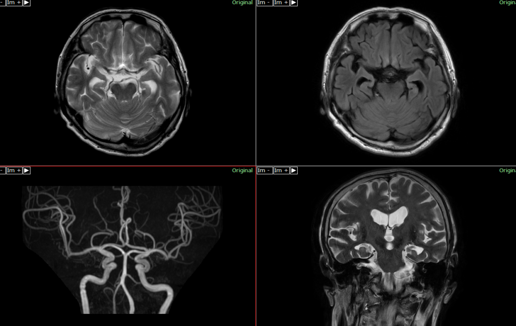 頭部MRI　アルツハイマー病