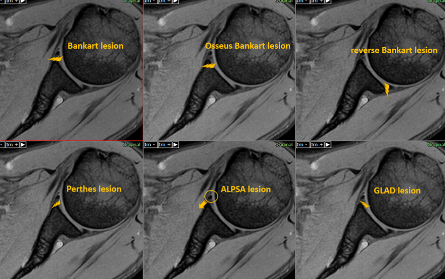 股関節唇裂傷の症状は何ですか?