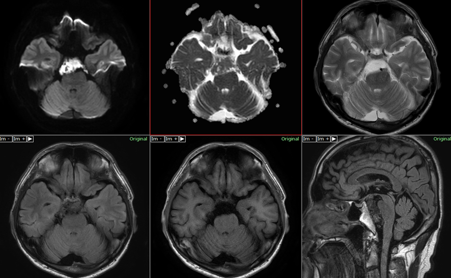 頭部MRI　類上皮嚢胞