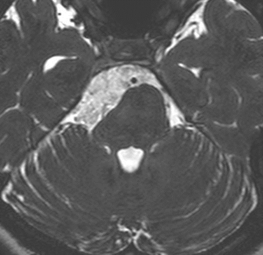 MRI画像　類表皮嚢胞