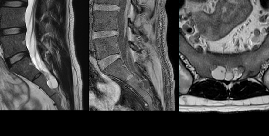 仙骨嚢腫MRI画像