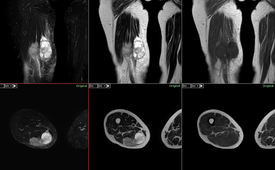 粘液型脂肪肉腫　MRI画像
