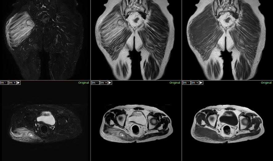 右臀部　筋肉内血腫　MRI画像