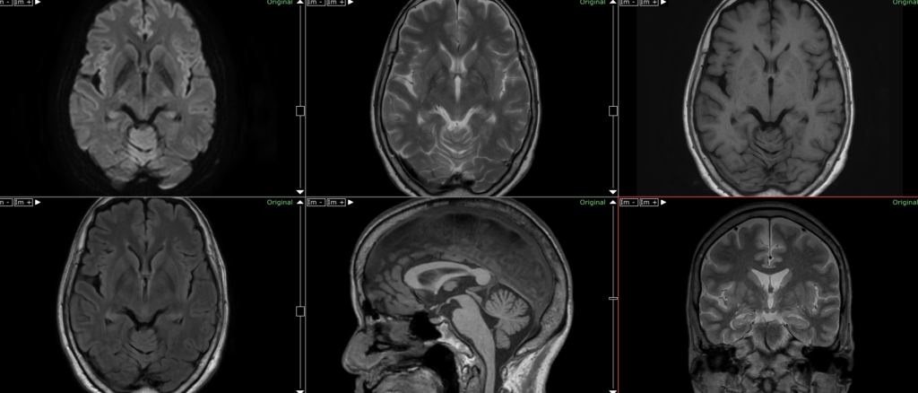 パーキンソン病のMRI画像