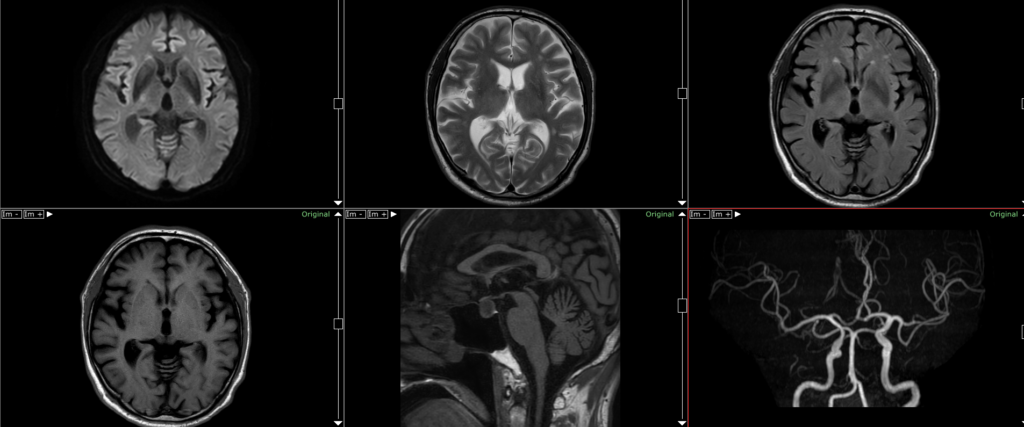 パーキンソン病のMRI画像