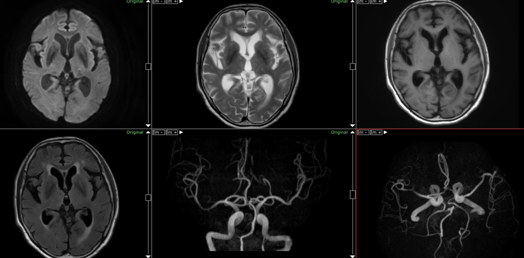 頭部MRI　レビー小体型認知症