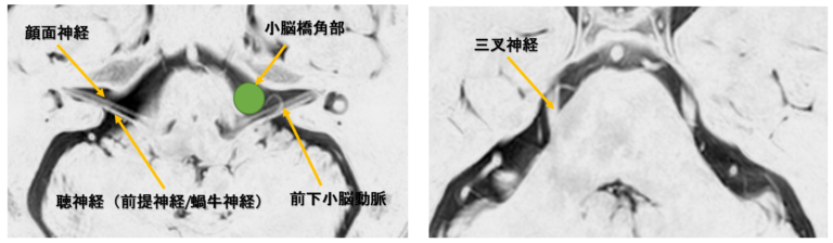 類表皮嚢胞（epidermoid cyst）