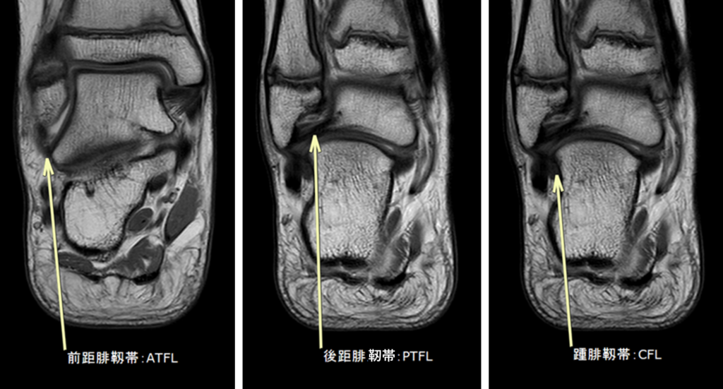 足関節外側靭帯