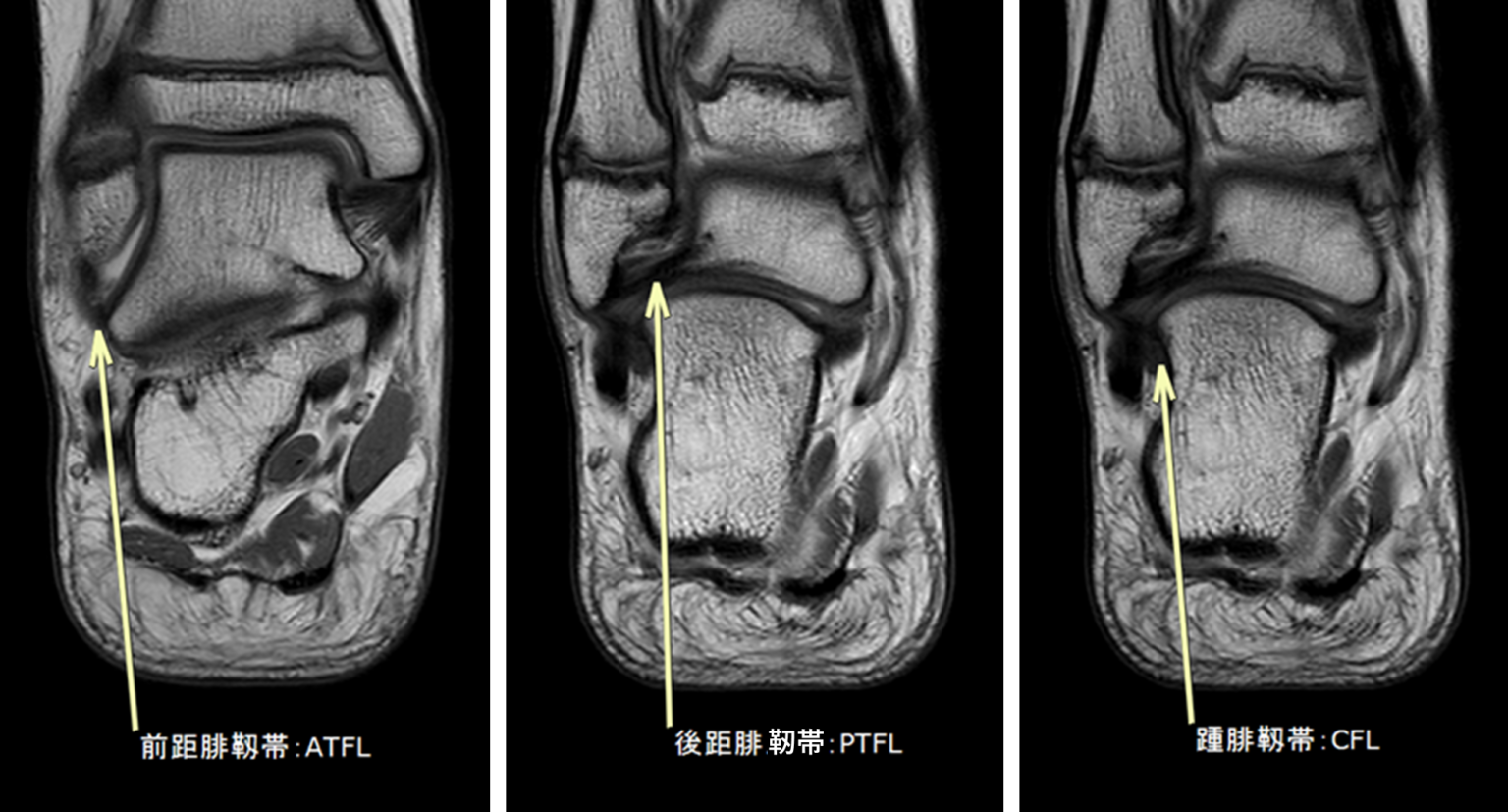 前距腓靱帯（anterior talofibular ligament：ATFL）損傷